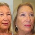 Exploring Aesthetic Clinic Reviews in the UK: The Role of Before and After Photos